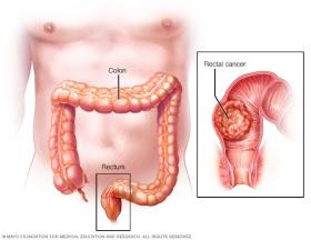 Có những đặc điểm này cần đề phòng ung thư trực tràng