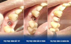 Công nghệ phục hình răng sứ trên implant DCT