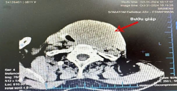  Bình Định: Phẫu thuật thành công khối bướu &apos;khủng&apos; cho cụ bà 81 tuổi 